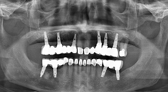 Panoramaröntgenaufnahme nach der Behandlung einer vollen Zirkonoxidbrücke auf sechs Implantate im Oberkiefer.