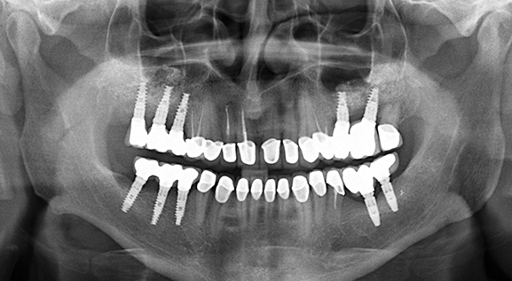 Panoramaröntgenaufnahme nach einer Zirkonoxidbrücke auf Implantaten für Molarzähne und Zirkonoxidkronen an den Frontzähnen