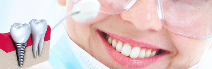 dental_implants