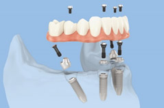 Mundrestaurierung mit minimalinvasive All-on-4 Prothese