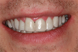 Nachher Veneers