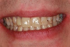 Vorher Veneers