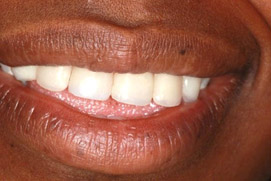Nachher Veneers