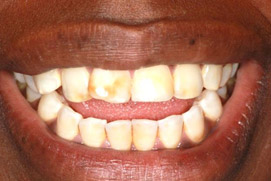 Vorher Veneers