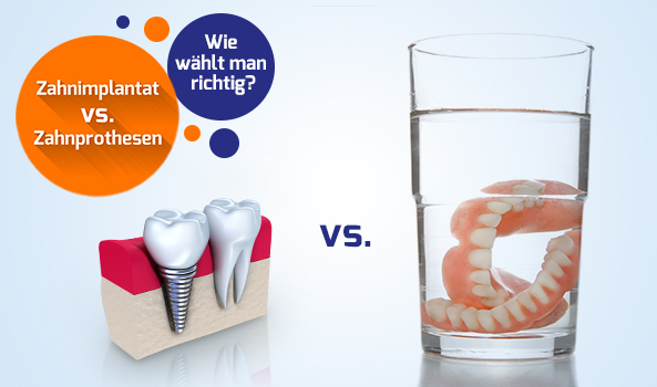 Zahnimplantat vs. Zahnprothesen