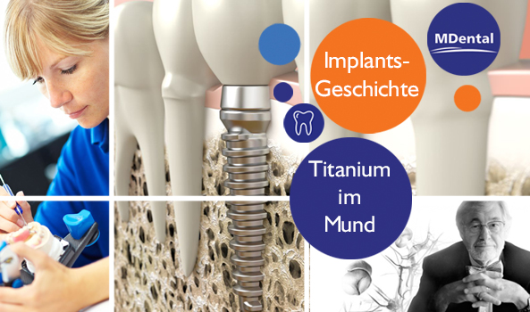 Titanium im Mund - Implantatsgeschichte