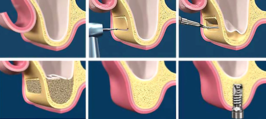 Das Prozess vom Sinus Lift